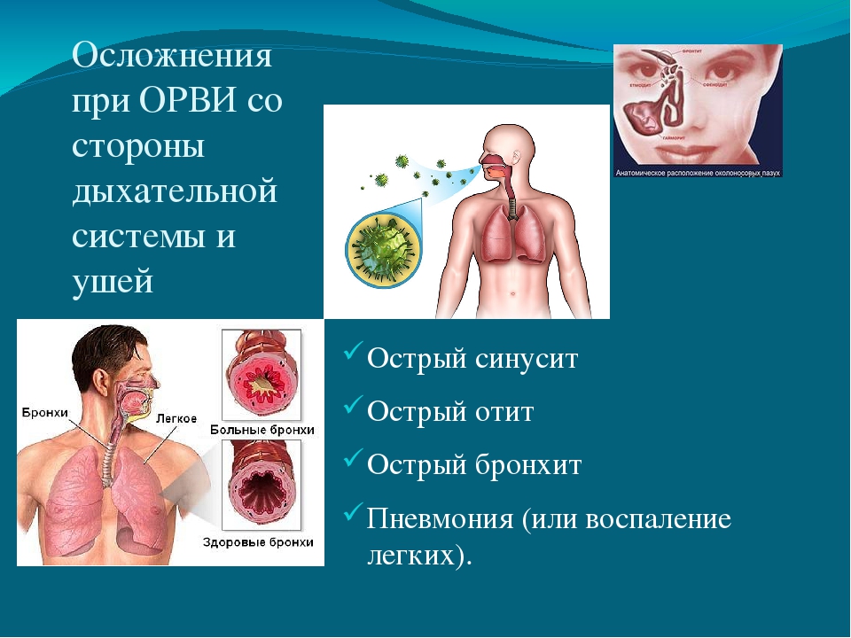 Презентация на тему: «Острые респираторно – вирусные инфекции»