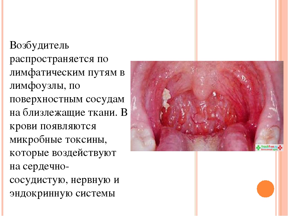 Презентация на тему "Скарлатина у детей дошкольного возраста"