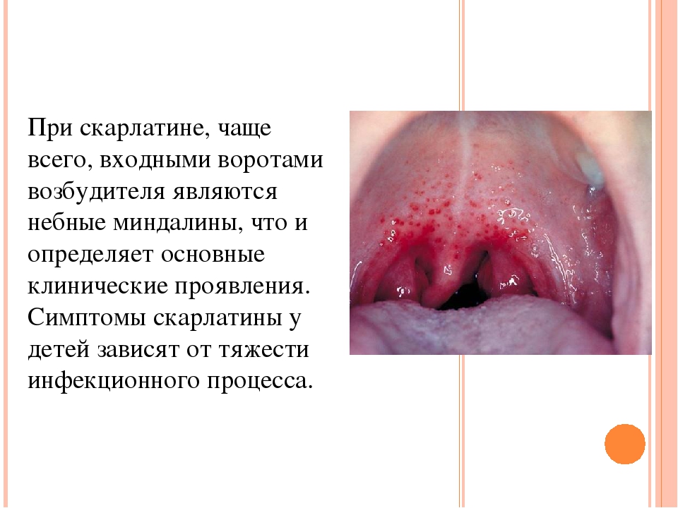 Презентация на тему "Скарлатина у детей дошкольного возраста"