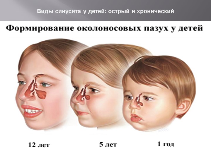 Презентация на тему Болезнь Синусит