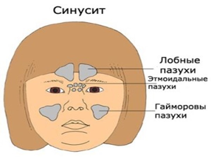 Презентация на тему Болезнь Синусит