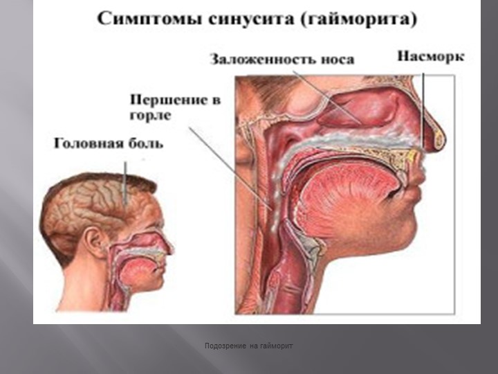 Презентация на тему Болезнь Синусит