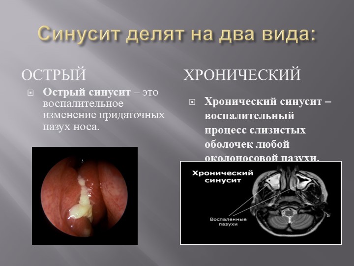 Презентация на тему Болезнь Синусит