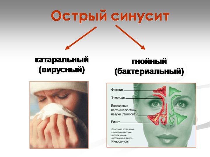 Презентация на тему Болезнь Синусит