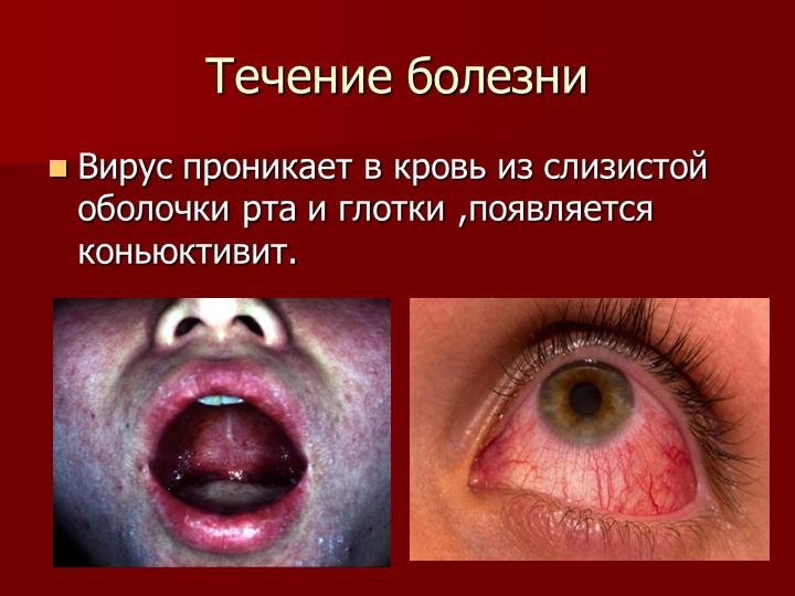 Презентация на тему "Корь. Помощь родителям"