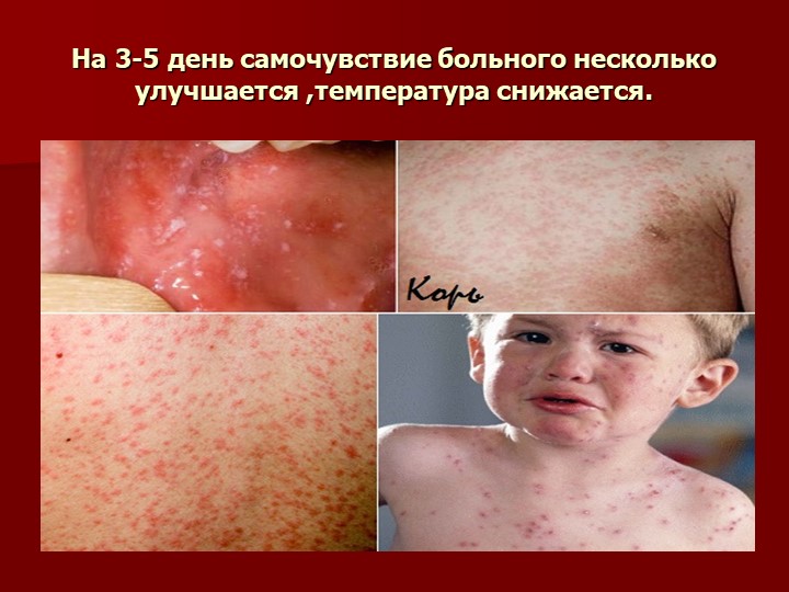 Презентация на тему "Корь. Помощь родителям"