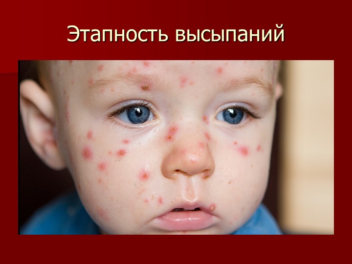 Презентация на тему "Корь. Помощь родителям"