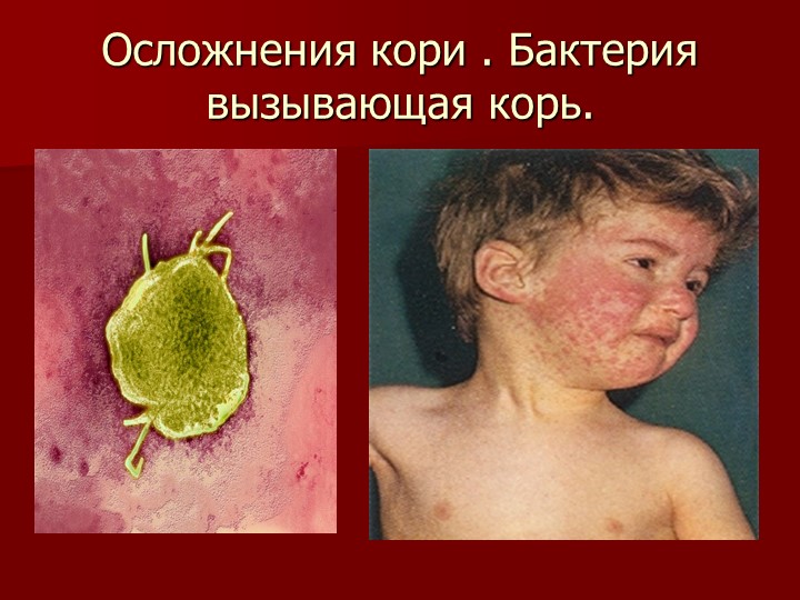 Презентация на тему "Корь. Помощь родителям"