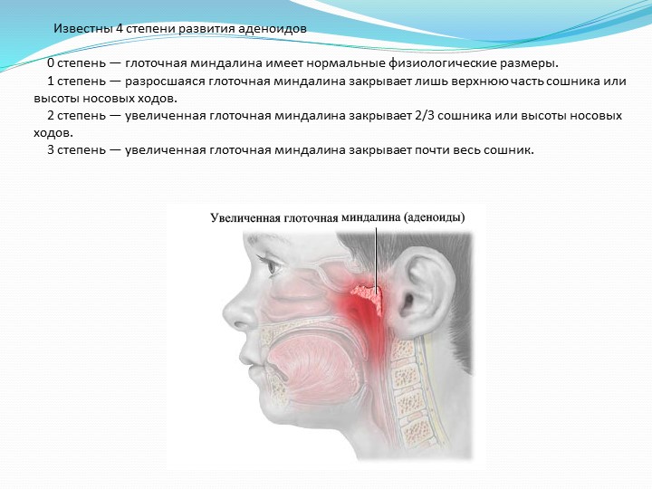 Презентация по предмету "Медико-биологические и социальные основы здоровья" на тему "Аденоидит"
