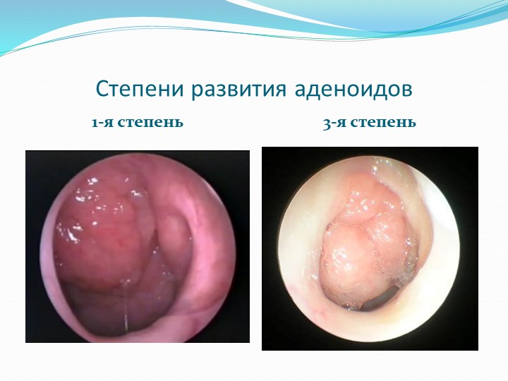 Презентация по предмету "Медико-биологические и социальные основы здоровья" на тему "Аденоидит"