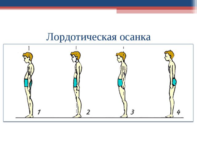 Формирование правильной осанки