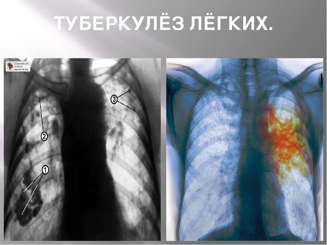 Презентация "24 марта - всемирный день борьбы с туберкулёзом"