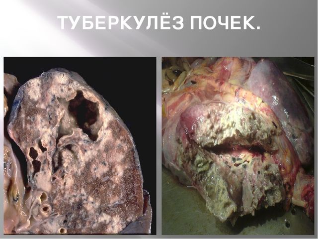 Презентация "24 марта - всемирный день борьбы с туберкулёзом"