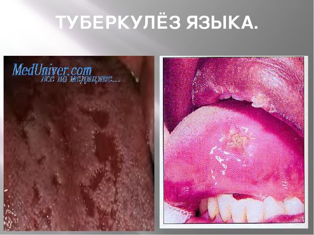 Презентация "24 марта - всемирный день борьбы с туберкулёзом"
