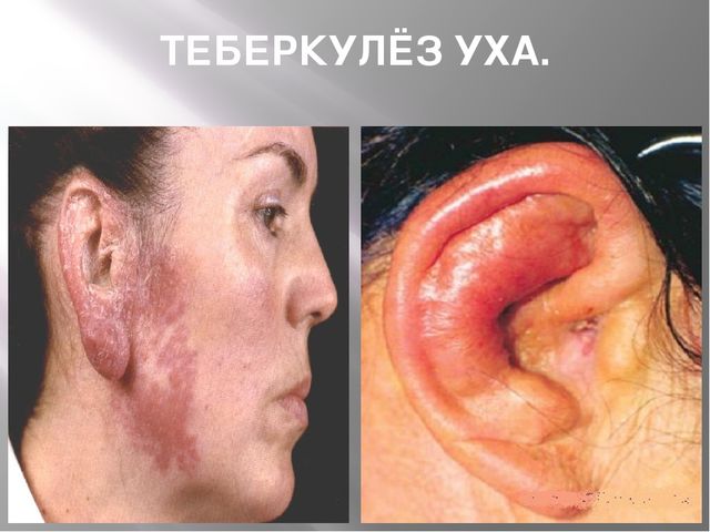 Презентация "24 марта - всемирный день борьбы с туберкулёзом"