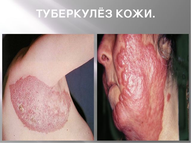 Презентация "24 марта - всемирный день борьбы с туберкулёзом"