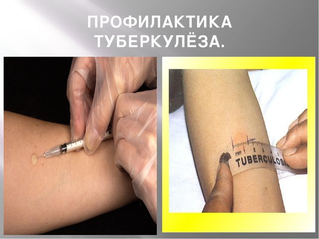 Презентация "24 марта - всемирный день борьбы с туберкулёзом"