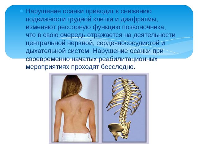 Презентация ЗОЖ "Правильная осанка"