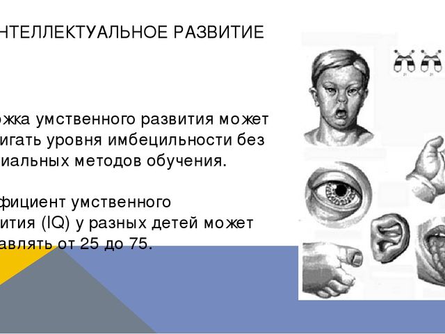 Презентация по логопедии на тему: "Оказание логопедической помощи ребенку с синдромом Дауна"