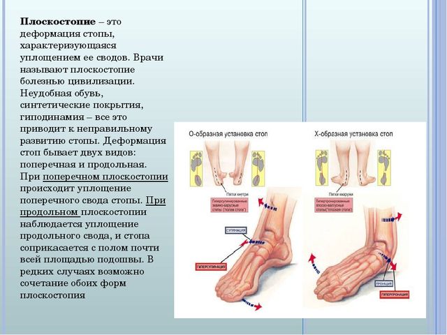 Консультация по теме "Коррекция и профилактика плоскостопия у дошкольников"